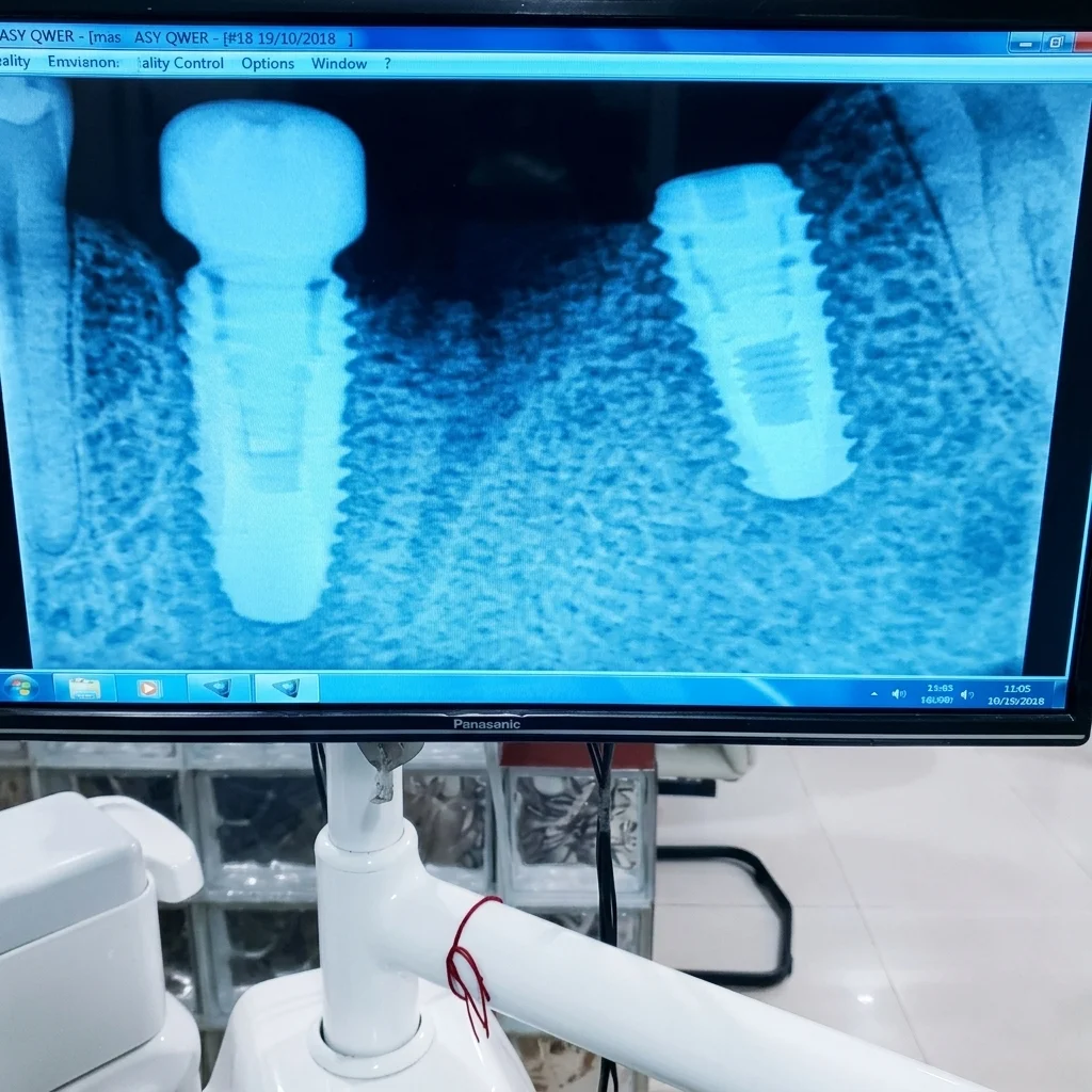 Digital X-Ray Machine